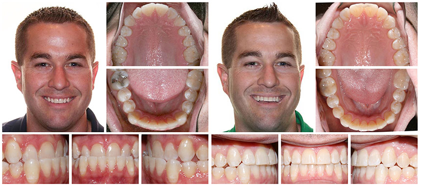 Orthodontics - Invisalign Before & After - Orthodontic therapy Ismile