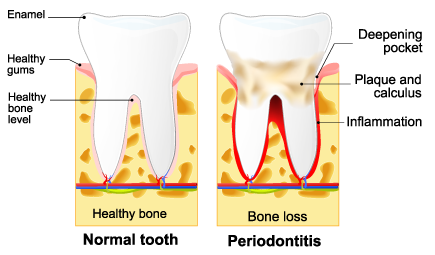 periodontal disease